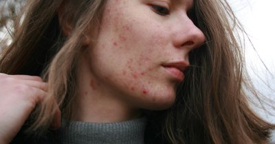 Alergia skórna: objawy i przyczyny
