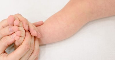 Objawy skórne alergii pokarmowej niemowląt